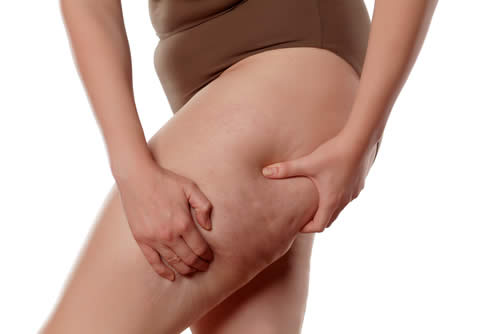 Cellulite | Stadi ed Evoluzione