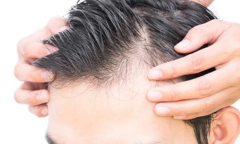 Capire di quale forma di alopecia si soffre è essenziale per trovare il trattamento anticaduta più sicuro ed efficace. Con questo articolo Impariamo a conoscere più da vicino l'alopecia, le varie forme di caduta dei capelli e sulle relative cause