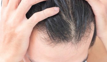 Questo Articolo analizza la più comune forma di calvizie: l'alopecia androgenetica. Analizzeremo insieme le cause del fenomeno, il ruolo degli ormoni maschili, i sintomi con cui si manifesta e i trattamenti anticaduta più efficaci