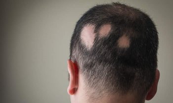 In questo articolo Parliamo nel dettaglio dell'Alopecia Areata, delle sue cause e dei relativi sintomi. Scoprirai gli esami utili per diagnosticarla e i trattamenti anticaduta più efficaci.