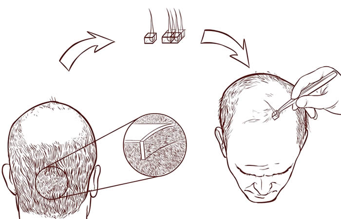 Tecnica FUT | Trapianto di Capelli