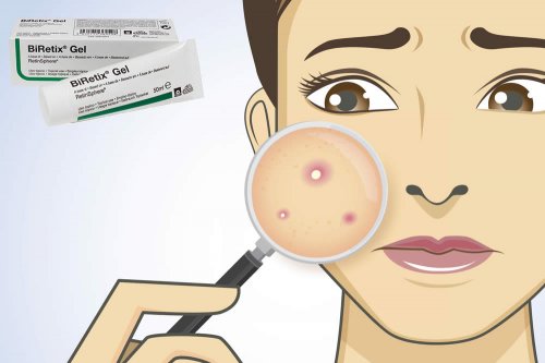 In questa recensione parliamo di Biretix Gel (utile nel trattamento dell'acne volgare, ad azione esfoliante, idratante e antiossidante), analizzandone ingredienti, prezzo, efficacia, modo d'uso e controindicazioni