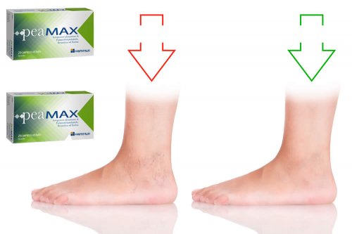 In questa recensione parliamo dell'Integratore Peamax (utile per la sua azione antiedemigena in presenza di traumi e/o gambe gonfie e pesanti), analizzandone ingredienti, composizione, efficacia, modo d'uso, controindicazioni ed effetti collaterali