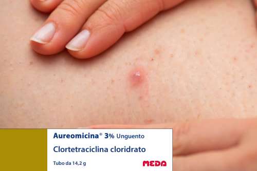 Recensione del Farmaco Aureomicina Pomata: A Cosa Serve? Quando Fa bene? Quando Fa Male? Per Cosa si Usa? Dosi e Uso Corretto della clortetraciclina cloridrato come Antibiotico. Uso in Gravidanza, Foglio Illustrativo Spiegato, Controindicazioni