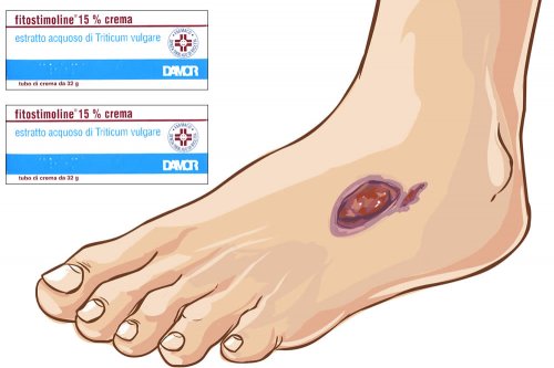 Recensione Fitostimoline Crema 15% (con Estratti di Triticum Vulgare), con tutte le informazioni del Foglio Illustrativo spiegate: A Cosa Serve? Come si Usa? Dosi e Uso corretto contro Ulcere e Piaghe da Decubito. Fa Male? Prezzo ed Effetti Collaterali